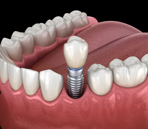 Dental implant illustration showing titanium screw, abutment, and crown in jaw model.