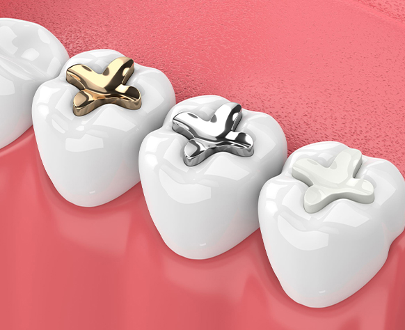 Three white tooth models on pink background showing dental filling and crown options.